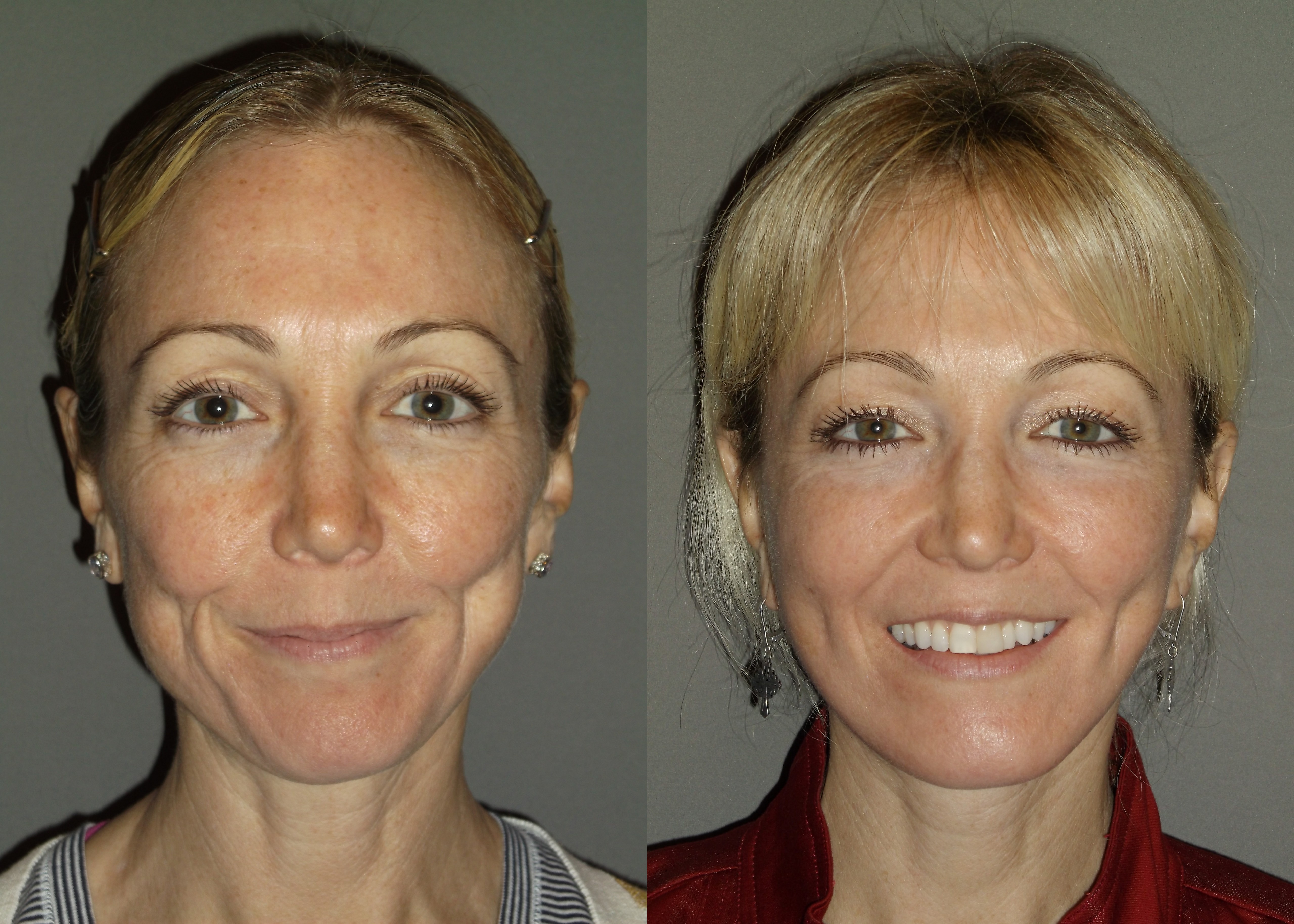 before and after facelift, neck lift, laser treatment and Sculptra by Dr. B...